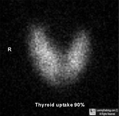 What is a thyroid uptake and scan test?